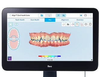 iTero 3D bite analysis displayed on a monitor