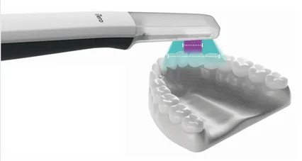 iTero scanner capturing a digital model of teeth