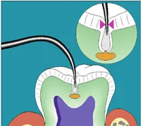 Diagnodent Laser Cavity Detection