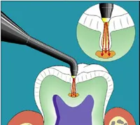 Diagnodent Laser Cavity Detection