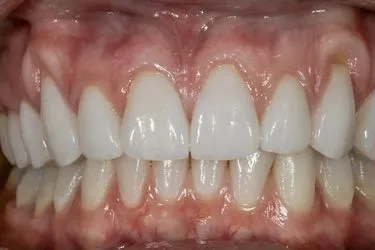 minimal-prep-veneers-01