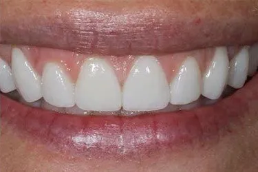 minimal-prep-veneers-02