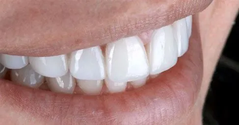 minimal-prep-veneers-img