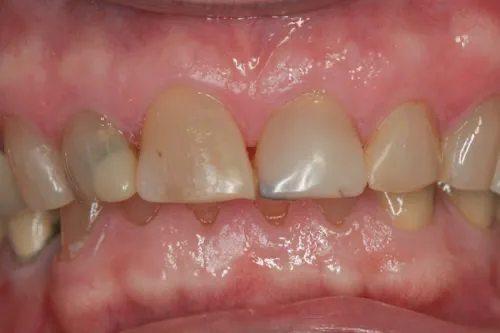 original_aging_and_old_fillings