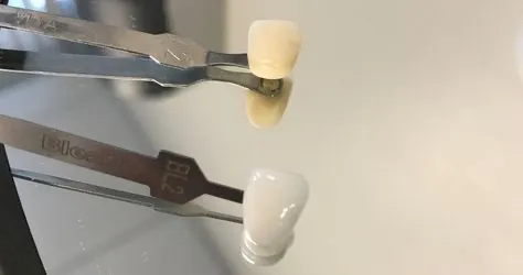 teeth-white-comparison