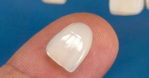 traditional-veneers-img