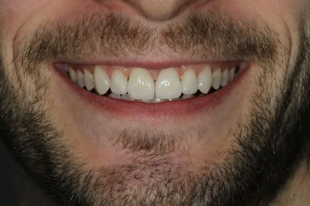 no-more-braces-after