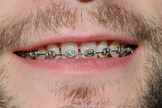 no-more-braces-before