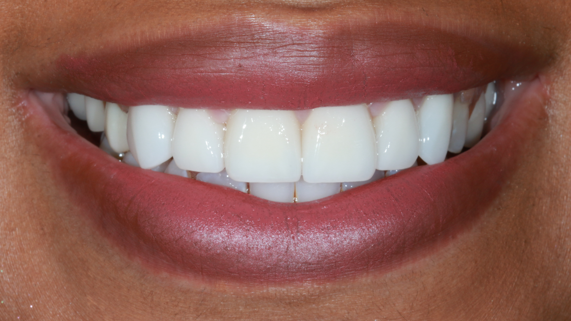 Porcelain-Veneers-After