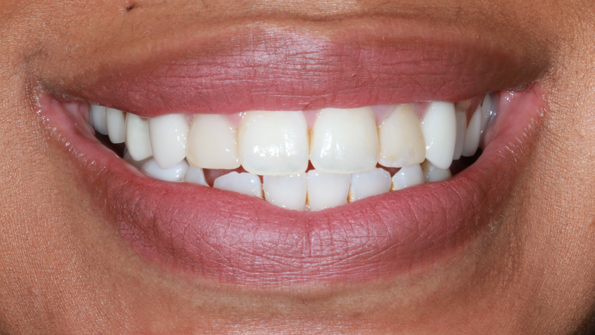Porcelain-Veneers-Before