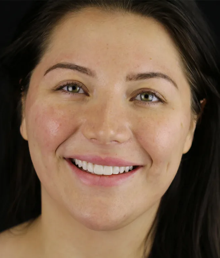 porcelain-veneers-case-01-after-f