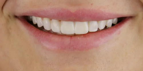 porcelain-veneers-case-01-after