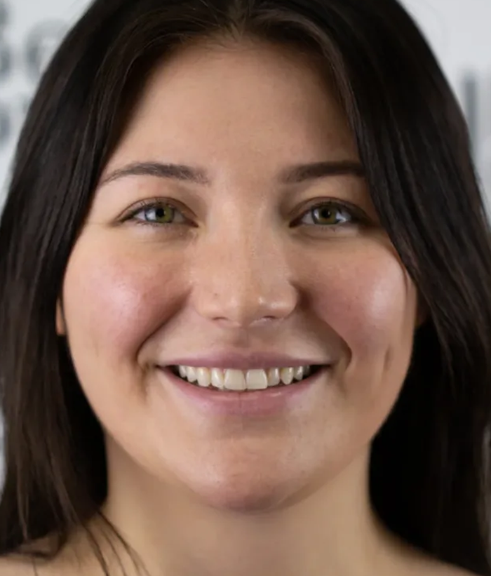 porcelain-veneers-case-01-before-f