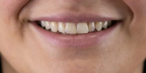 porcelain-veneers-case-01-before