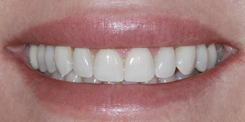 porcelain-veneers-case-02-after