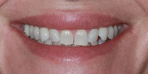 porcelain-veneers-case-02-before