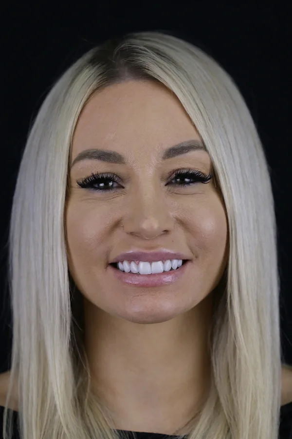 porcelain-veneers-case-03-after-f