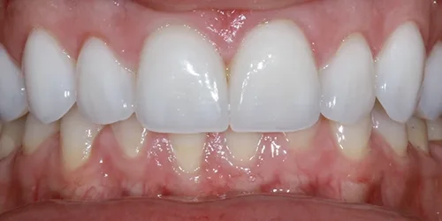 porcelain-veneers-case-03-after