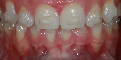 porcelain-veneers-case-03-before