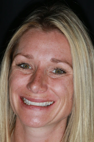 porcelain-veneers-case-04-after-f