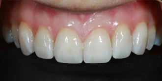 porcelain-veneers-case-04-after