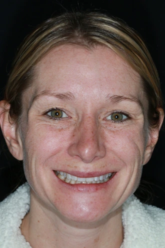 porcelain-veneers-case-04-before-f