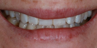 porcelain-veneers-case-04-before