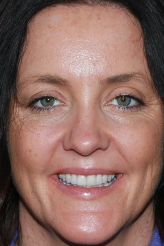 porcelain-veneers-case-05-after-f