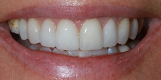 porcelain-veneers-case-05-after