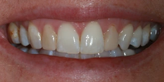 porcelain-veneers-case-05-before