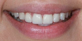 porcelain-veneers-case-05-after