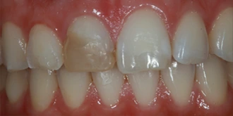 porcelain-veneers-case-05-before