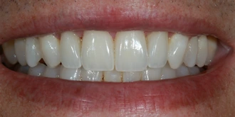 porcelain-veneers-case-05-after