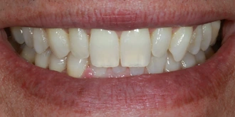 porcelain-veneers-case-05-before