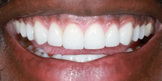 porcelain-veneers-case-05-after