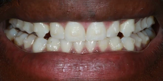 porcelain-veneers-case-05-before
