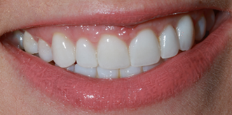 Porcelain-Veneers-Top-after