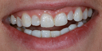 Porcelain-Veneers-Top-Before
