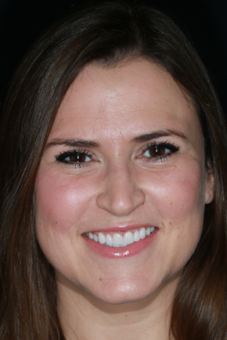 Porcelain-Veneers-TopFullFace-After