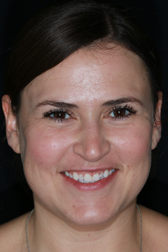 Porcelain-Veneers-TopFullFace-before