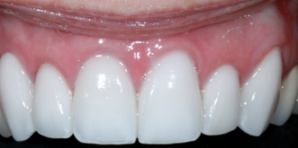 Porcelain-Veneers1-Top-after