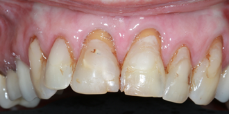 Porcelain-Veneers1-Top-Before