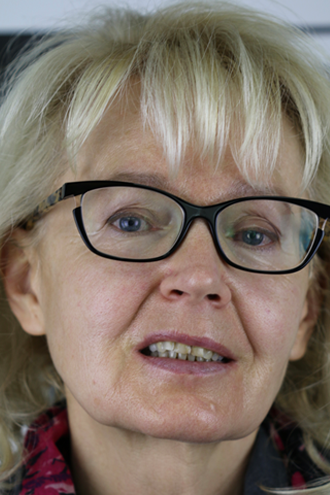 Porcelain-Veneers1-TopFullFace-Before