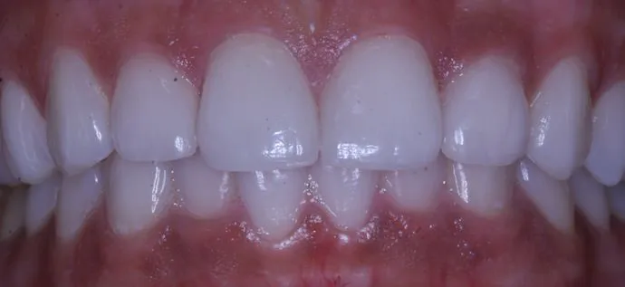 teeth-spacing-after-02