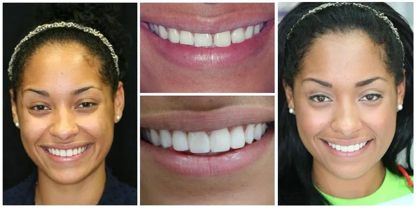 teeth-spacing-after-full-face-02