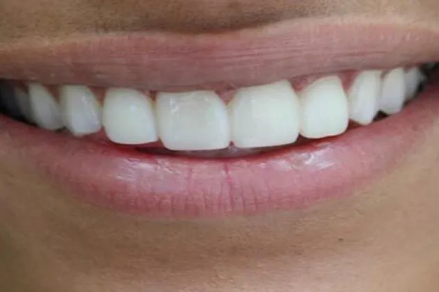 teeth-spacing-after