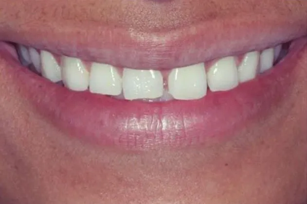 teeth-spacing-before