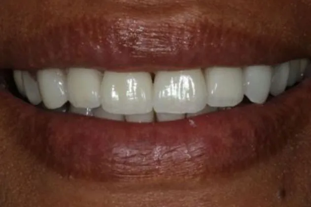 worn-dentition-after