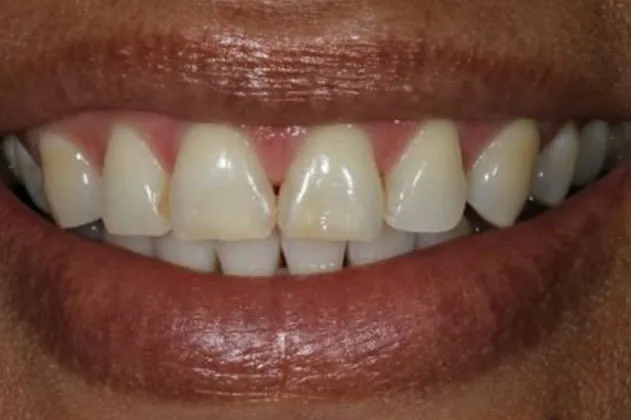 worn-dentition-before