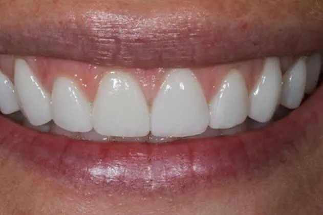 worn-down-teeth-from-grinding-after